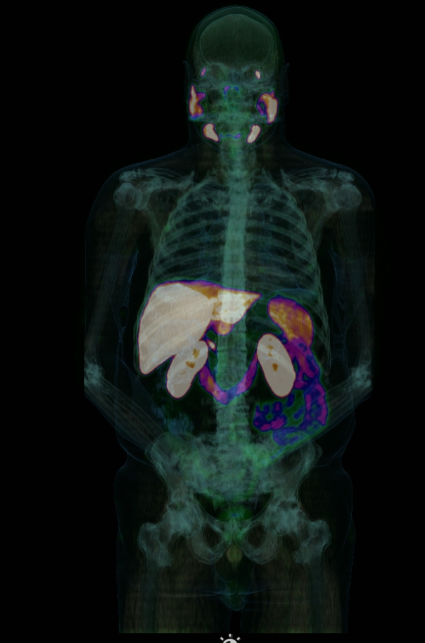 PET CT image