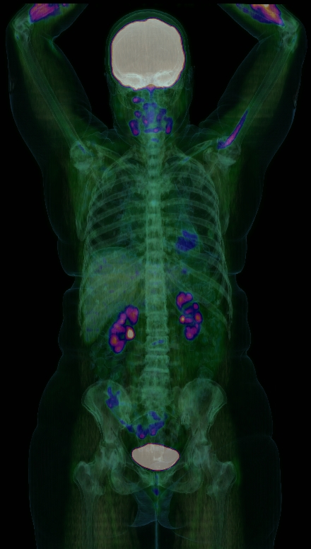 PET CT image