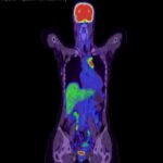 Mediastinal Nodes