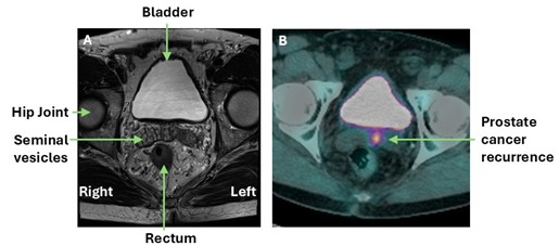 Comparison of MRI & PET CT prostate scans